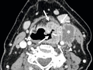 Figure 24.12 Carcinome épidermoïde du sinus piriforme gauche. TDM injectée en coupe axiale centrée sur les sinus piriformes. Formation tumorale des parois du sinus piriforme gauche (flèches) rehaussée par le produit de contraste ; volumineuse adénopathie jugulocarotidienne homolatérale nécrotique en rupture capsulaire (étoile) englobant la veine jugulaire gauche thrombosée (tête de flèche).