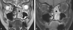 Figure 24.13 Adénocarcinome de l'ethmoïde gauche. IRM en séquence coronales T2 (A) et T1 avec suppression de graisse après injection intraveineuse de gadolinium. B. Masse tumorale ethmoïdale gauche de signal tissulaire (étoiles) (hypo-intense T2 (A), globalement rehaussée après injection de gadolinium (B).