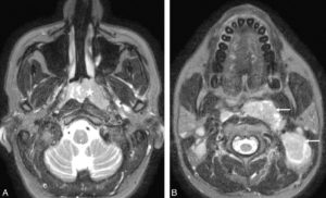 Figure 24.14 Bilan d'extension d'une tumeur du nasopharynx. A. L'IRM à l'étage des fosses nasales montre une masse du nasopharynx (étoile) infiltrant à gauche les espaces parapharyngés et les muscles prévertébraux. B. À l'étage oropharyngé, on met en évidence de volumineuses adénopathies latérocervicales et rétropharyngées (flèches).