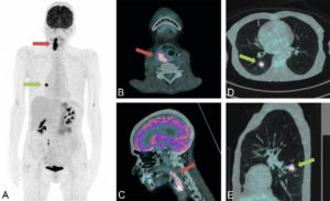 Figure 24.15 Bilan d'extension d'un carcinome épidermoïde du laryngopharynx droit. Images TEP au 18F-FDG en reconstruction MIP (A) et fusionnées au TDM en coupes axiales (B en fenêtre tissus mous et D en fenêtre pulmonaire) et sagittales (C en fenêtre tissus mous et E en fenêtre pulmonaire). Hyperfixation très intense (SUVmax = 12,6) d'une lésion comblant le laryngopharynx droit et s'étendant localement à l'oropharynx sur 7 cm de hauteur (flèches rouges). Absence d'adénomégalies hyperfixantes associées suspectes. Hyperfixation intense (SUVmax = 9,4) d'un nodule pulmonaire centimétrique unique du segment apical du lobe inférieur droit (flèches vertes) sans adénopathie médiastino-hilaire associée. Conclusion : hypermétabolisme pathologique de la tumeur laryngopharyngée droite localement avancée. Absence d'arguments scintigraphiques en faveur d'une extension lymphatique cervicale. Foyer hypermétabolique significatif d'une opacité pulmonaire isolée du segment apical du lobe inférieur droit suggérant en premier lieu une tumeur synchrone.