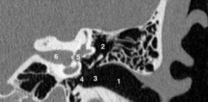 Figure 24.2 TDM d'un rocher normal en coupe coronale. 1. Méat acoustique externe ; 2. récessus épitympanique de la cavité tympanique ; 3. incus ; 4. incus (incus et stapes formant le « V ossiculaire ») ; 5. labyrinthe osseux : vestibule ; 6. méat acoustique interne.