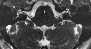 Figure 24.3 IRM de l'angle pontocérébelleux en séquence « liquidienne » haute résolution. 1. Pont ; 2. LCS de la citerne prépontique ; 3. nerf facial (VII) ; 4. nerf vestibulocochléaire (VIII) ; 5. liquide périlymphatique du tour basal de la cochlée.