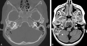 Figure 24.4 Céphalées fébriles chez un enfant de 5 ans : mastoïdite droite compliquée de thrombose du sinus latéral et d'abcès cérébelleux. A. La TDM du rocher montre un comblement des cellules mastoïdiennes droites (étoile) et de la cavité tympanique associée à une lyse osseuse de la corticale postérieure du rocher (flèche). B. L'IRM en séquence pondérée T1 après injection de gadolinium montre le comblement des cellules mastoïdiennes (étoile) et les complications endocrâniennes : thrombus au sein du sinus veineux latéral droit sous forme d'un défaut de rehaussement au sein du sinus (flèche) et abcès cérébelleux droit sous forme d'une collection intra-axiale avec prise de contraste périphérique (tête de flèche).