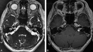 Figure 24.5 Surdité gauche révélant un schwannome (ou neurinome) du nerf vestibulocochléaire. A. L'IRM des méats acoustiques internes en séquence pondérée T2 haute résolution permet de visualiser le « paquet » acousticofacial droit cheminant dans le méat acoustique interne et moulé par le LCS (tête de flèche), alors qu'à gauche le méat acoustique interne est comblé par une masse (étoile). Cette séquence permet aussi la visualisation des liquides de l'oreille interne, dont le signal est abaissé (plus gris) à gauche par le neurinome obstructif (flèche). B. Après injection de gadolinium sur une séquence pondérée T1, le schwannome se rehausse fortement (étoile).