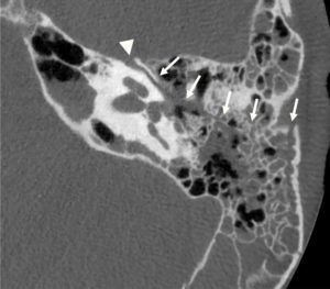 Figure 24.6 Fracture longitudinale du rocher gauche passant par la loge du ganglion géniculé avec paralysie faciale immédiate post-traumatique. CBCT en coupes axiale du rocher gauche : trait de fracture (flèches) de l'écaille du temporal passant par le ganglion géniculé (tête de flèche).