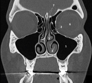 Figure 24.7 TDM d'un massif facial normal en coupe coronale et en fenêtre osseuse. 1. Sinus maxillaire ; 2. méat moyen ; 3. cornet moyen ; 4. cornet inférieur ; 5. cellule ethmoïdale ; 6. orbite ; 7. gouttière olfactive (dans laquelle est localisé le bulbe olfactif).