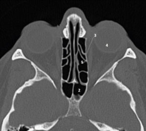 Figure 24.8 TDM d'un massif facial normal en coupe axiale. 1. Cellule ethmoïdale ; 2. sinus sphénoïdal ; 3. lame papyracée ; 4. orbite.