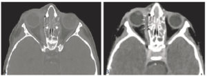 Figure 24.9 Ethmoïdite droite compliquée d'un abcès sous-périosté extraconal de l'orbite chez un enfant de 12 ans. A. La TDM du massif facial en fenêtre osseuse met en évidence le comblement bilatéral des cellules ethmoïdales (étoiles). B. La TDM après injection en fenêtre tissus mous révèle une collection abcédée sous-périostée intra-orbitaire, mais extraconale (flèches) – c'est-à-dire située en dehors du cône musculaire de l'orbite – contenant une bulle de gaz (tête de flèche). À noter que la graisse orbitaire intraconale est légèrement infiltrée (plus blanche).