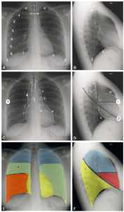 Figure 25.1 Radiographies normales du thorax, de face et de profil. A, B. Critères de qualité et éléments anatomiques. Visibilité des apex (α) et des culs-de-sac pleuraux (β), d'au moins six arcs costaux antérieurs au-dessus des coupoles diaphragmatiques (γ) et projection symétrique des articulations sternoclaviculaires (double flèche blanche) par rapport à la ligne des processus épineux (ligne en pointillés). C, D. Structures médiastinales et scissures principales. Structures médiastinales (lignes blanches en pointillés). 1. Trachée ; 2. Carène ; 3. crosse aortique ; 4. bord gauche de l'aorte descendante ; 5. artère pulmonaire ; 6. ventricule gauche ; 7. atrium droit ; 8. veine cave supérieure ; 9. bord postérieur de la trachée ; 10. infundibulum du ventricule droit ; 11. bord supérieur et postérieur de la crosse aortique. Scissures (lignes noires). 1. Petite scissure ; 2. grande scissure (droite et gauche sont représentées superposées). E, F. Représentation des lobes pulmonaires et de leurs superpositions. En bleu : lobe supérieur ; en jaune : lobe inférieur ; en rouge : lobe moyen. Sur la radiographie de thorax de face, les lobes se superposent : la partie la plus apicale du lobe inférieur avec le lobe supérieur (*, vert) et le lobe moyen avec le lobe inférieur droit (orange). Sur le cliché de profil, seule la segmentation du poumon droit est représentée.