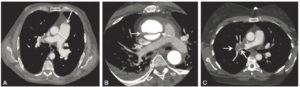 Figure 25.10 TDM thoraciques en coupe axiale et en fenêtre médiastinale, montrant différentes pathologies visibles grâce à l'injection de produit de contraste. A. Artère pulmonaire augmentée de taille (flèche), avec un tronc mesurant 37 mm de diamètre, ce qui est un signe d'hypertension pulmonaire. B. Image hypodense linéaire au sein de l'aorte ascendante, correspondant à un flap intimal (flèches) : dissection aortique ascendante. Il existe un épanchement péricardique et pleural associé. C. Image hypodense de type défect endoluminal au sein de l'artère pulmonaire droite : une embolie pulmonaire aiguë (flèches).