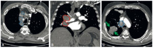 Figure 25.11 Patient de 56 ans suivi pour adénocarcinome pulmonaire. TDM thoracique injectée en coupes axiales (A, C) et coronale (B), mettant en évidence de multiples adénomégalies médiastinales en latérotrachéal droit (A, C, ronds bleus) et en hilaire droit (B, ronds rouges) secondaires au cancer lobaire inférieur droit (C, flèches vertes).