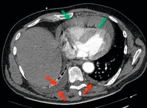 Figure 25.12 Patient de 74 ans avec syndrome inflammatoire. TDM thoracique injectée en coupe axiale et en fenêtre médiastinale montrant un épanchement pleural bilatéral (flèches rouges) et un épanchement péricardique (flèche verte) de plus de 1 cm d'épaisseur, de forte abondance. Tous ces épanchements ont une densité faible (ils sont « gris foncé ») qui correspond à une densité liquidienne.