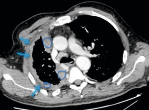 Figure 25.13 TDM thoracique injectée en coupe axiale du patient de la figure 25.6, montrant un épaississement pleural droit (flèches) dense constitué de plusieurs nodules tissulaires (ronds bleus) (a contrario des anomalies de densité liquidienne de la figure 25.12), différents d'un simple épanchement liquidien, en rapport avec un mésothéliome.