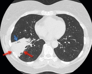 Figure 25.14 TDM thoracique en coupe axiale et en fenêtre parenchymateuse chez une patiente de 61 ans admise aux urgences pour dyspnée fébrile. Mise en évidence d'une condensation alvéolaire bien systématisée lobaire inférieure droite (flèches rouges) avec bronchogramme aérique (flèche bleue), correspondant à une pneumopathie franche lobaire aiguë.