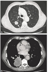 Figure 25.15 A. Patient de 69 ans, fumeur. TDM thoracique en coupe axiale et en fenêtre parenchymateuse montrant un nodule spiculé du lobe supérieur droit (flèche). Le caractère spiculé et la taille de ce nodule sont très évocateurs d'un cancer pulmonaire primitif. B. Patient de 79 ans, fumeur. TDM thoracique injectée en coupe axiale et en fenêtre médiastinale démontrant une masse de 7 cm du lobe inférieur droit, avec des contours irréguliers spiculés et un centre hypodense correspondant à de la nécrose (flèches). L'association d'une lésion de plus de 3 cm (masse), de contours irréguliers et d'un centre nécrotique est très évocatrice d'une néoplasie pulmonaire primitive. Cependant, cet aspect peut également être trouvé en présence d'un abcès pulmonaire.