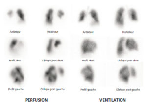 Figure 25.16 Patient de 68 ans adressé aux urgences pour dyspnée et douleur thoracique. La scintigraphie de perfusion met en évidence de multiples hypofixations segmentaires et sous-segmentaires systématisées, bilatérales, non retrouvées sur les images de ventilation. L'examen est donc très évocateur d'une embolie pulmonaire récente.