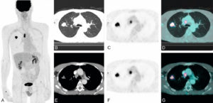 Figure 25.17 Patient de 65 ans, fumeur, adressé pour caractérisation et bilan d'extension d'une masse pulmonaire droite. Images TDM (B et E), TEP-FDG (A, C et F) et TEP-FDG fusionnées à la TDM (D et G) montrant une hyperfixation très intense de la masse pulmonaire droite, confirmant son caractère très suspect. Il s'y associe une hyperfixation très intense d'une adénopathie latérotrachéale droite, faisant fortement suspecter une extension ganglionnaire médiastinale homolatérale. En revanche, absence d'hyperfixations évocatrices d'une atteinte ganglionnaire médiastinale controlatérale, viscérale ou osseuse.