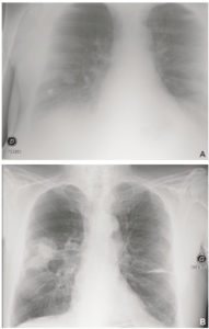 Figure 25.2 Patient de 68 ans, admis aux urgences pour altération de l'état général avec dyspnée. Un premier cliché de radiographie du thorax (A) est réalisé à l'admission, à 23 heures. Il est techniquement insuffisant, mal cadré (il manque l'apex droit et le cul-de-sac gauche), n'est pas de face et est mal inspiré (position assise, on ne voit pas assez d'espaces intercostaux). B. Un cliché est réalisé le lendemain matin, en position debout, avec une inspiration suffisante, et démasque deux masses spiculées lobaires supérieures droites en rapport avec une néoplasie primitive.