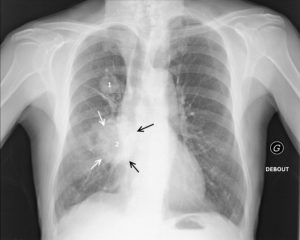 Figure 25.3 Patient de 54 ans, fumeur, avec un double cancer pulmonaire droit. La radiographie du thorax objective un nodule du lobe supérieur droit (1) de contours spiculés, et une masse à contours spiculés (flèches blanches) en projection de la base pulmonaire droite (2). La masse 2 est soit dans le lobe moyen, soit dans le lobe inférieur. Si une opacité de tonalité hydrique se trouve dans le lobe moyen, son bord interne se confond avec le bord droit du cœur. Or, ici, la masse est silhouettée par de l'air sur son bord interne (flèches noires), ce qui signifie qu'elle n'est pas dans le plan du cœur, mais plus postérieure ; c'est le signe de la silhouette. La masse 2 se situe donc dans le lobe inférieur droit.