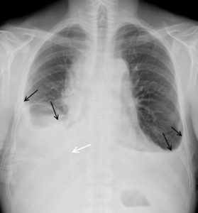 Figure 25.4 Patient de 46 ans, admis aux urgences pour dyspnée et douleur thoracique. Comblement des culs-de-sac pleuraux latéraux par une opacité concave vers le haut, bien délimitée, à angle de raccordement pleural doux, correspondant à un épanchement pleural bilatéral. La limite de cet épanchement (flèches noires) est appelée ligne de « Damoiseau ». À droite, un drain pleural a été posé (flèche blanche). Noter la disparition des contours normaux des coupoles diaphragmatiques en raison d'un signe de la silhouette.