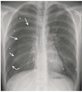 Figure 25.5 Patient de 18 ans, admis aux urgences pour douleur thoracique droite secondaire à une chute d'un arbre. On visualise une hyperclarté hémithoracique périphérique droite (astérisques), avec une absence de trame alvéolo-interstitielle et une ligne pleurale (flèches) délimitant de manière nette le poumon droit tassé : pneumothorax droit secondaire à une fracture costale (flèche courbe).