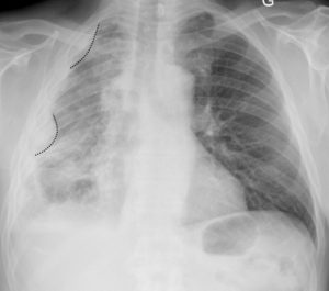 Figure 25.6 Patient de 57 ans exposé professionnellement à l'amiante. Multiples opacités pleurales droites, à angle de raccordement doux, réalisant un aspect festonné de la plèvre. Il s'agit d'un aspect évocateur d'une tumeur primitive de la plèvre, le mésothéliome. Il s'accompagne d'une perte de volume du poumon droit.