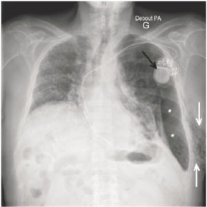 Figure 25.7 Patient de 87 ans porteur d'une fibrose pulmonaire idiopathique. Pneumothorax gauche (astérisque) avec emphysème sous-cutané pariétal axillaire gauche (flèches blanches), se manifestant sous la forme de clartés linéaires d'extension limitée. Noter l'aspect pathologique du parenchyme pulmonaire droit en rapport avec la fibrose. Présence par ailleurs d'un pace-maker (flèche noire).