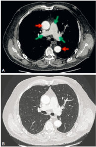 Figure 25.8 Coupes axiales d'une TDM thoracique, en fenêtre médiastinale (A) et en fenêtre parenchymateuse (B). Le caractère injecté ou non de l'examen se détermine sur la fenêtre médiastinale. Ici, cette TDM est injectée, car il existe un rehaussement des vaisseaux (aorte, flèches rouges ; et artères pulmonaires, flèches vertes).