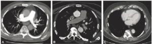 Figure 25.9 TDM thoraciques injectés, en coupe axiale et en fenêtre médiastinale. A. L'artère pulmonaire et ses branches sont bien opacifiées (« blanches ») et l'aorte est encore grise ; il s'agit donc d'un temps artériel pulmonaire. B. L'aorte est bien opacifiée (« blanche ») et les artères pulmonaires ne sont plus aussi « blanches » qu'en (A) ; il s'agit d'un temps artériel aortique. C. Les cavités cardiaques droite et gauche sont opacifiées de manière homogène ; il s'agit d'un temps veineux (dit d'équilibre).