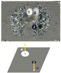 Figure 26.11 Imagerie de cartographie des flux dans un plan axial passant par l'aorte ascendante (en blanc) et l'aorte descendante (en noir). Le niveau de gris de chaque point représente une vitesse et une direction (blanc et noir correspondent aux vitesses maximales, gris correspond à une vitesse nulle). 1. Aorte ascendante ; 2. aorte descendante ; 3. artère pulmonaire ; 4. poumon gauche ; 5. poumon droit.