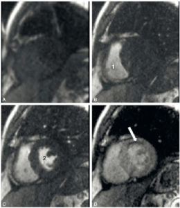 Figure 26.12 Images IRM successives d'un même plan de coupe petit axe au cours du premier passage d'un agent de contraste à base de gadolinium (séquence turbo FLASH précédée d'une impulsion saturation-récupération). A. Avant le passage de l'agent de contraste. Les seules zones en hypersignal (blanc) correspondent à la graisse sur cette séquence fortement pondérée en T1. B. Arrivée de l'agent de contraste dans la cavité ventriculaire droite (1). C. Passage de l'agent de contraste dans la cavité ventriculaire gauche (2). D. Passage de l'agent de contraste dans le myocarde dont le signal augmente, sauf dans la région antérieure (flèche). L'hyposignal correspond à un déficit de perfusion du myocarde.