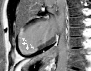 Figure 26.13 Séquence IRM de rehaussement tardif, 10 minutes après injection d'un agent de contraste à base de gadolinium. Orientation grand axe vertical. On observe un hypersignal dans le tiers distal du VG, transmural, correspondant à une rétention du traceur du fait d'une large séquelle d'infarctus myocardique (flèches). Il existe également un épanchement péricardique liquidien, apparaissant en noir sur cette séquence fortement pondérée en T1 (astérisque).