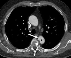 Figure 26.14 Angio-TDM aortique dans le plan axial. Dans la lumière circulante de l'aorte thoracique descendante (étoile), il existe une hypodensité correspondant à un thrombus (tête de flèche). Noter également la paroi aortique (flèche) visible sur cet examen, modérément épaissie.