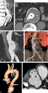 Figure 26.15 Anévrismes. A. Reconstruction en MIP épaisse en sagittal oblique d'une angio-TDM de l'aorte abdominale, montrant un anévrisme fusiforme de celle-ci. Noter les calcifications pariétales diffuses (athérome), la lumière et le thrombus. B. Coupe axiale du même patient, à environ mi-hauteur de cet anévrisme ; lumière circulante (étoile noire) et thrombus (étoile blanche). C, D. Anévrisme sacciforme de l'aorte abdominale en angioTDM en reformation (C) et rendu volumique 3D (D). Noter le développement unilatéral à gauche de cet anévrisme (étoile noire : lumière circulante ; étoile blanche : thrombus). E. Rendu volumique 3D d'un angioTDM de l'aorte chez un patient présentant de multiples anévrismes sacciformes (flèches blanches). F. Coupe axiale au niveau de la racine de l'aorte montrant un de ces anévrismes (étoile noire) développé aux dépens du sinus antérieur droit (rond noir), et situé à côté de l'ostium de la coronaire droite (tête de flèche).