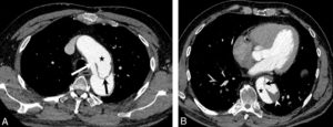 Figure 26.16 Dissection. Coupes axiales d'angio-TDM au temps artériel passant par la crosse aortique (A) et l'aorte thoracique descendante distale (B). Brèche intimale (flèche blanche) située ici au niveau de la crosse aortique, au pied de l'artère subclavière gauche (dissection de type B selon Stanford), se présentant comme une discontinuité dans la paroi aortique ; il peut exister une ou plusieurs réentrées, qui se présentent de la même façon et situées plus en distalité sur l'aorte ou ses collatérales. Existence d'un vrai chenal (étoiles noires) et d'un faux, séparés par le flap intimal (flèches noires et blanche) ; noter le thrombus (tête de flèche blanche) qui obstrue partiellement la lumière du faux chenal de l'aorte thoracique descendante distale dans ce cas.