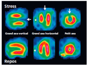 Figure 26.17 Scintigraphie myocardique au 99mTc-MIBI : ischémie. L'injection du traceur et l'acquisition des images sont réalisées au décours d'un effort (stress) et quelques heures plus tard au repos, après réinjection. On constate une absence de perfusion dans le territoire apical et antérieur distal en post-stress (flèches), qui se rétablit au repos. Il s'agit d'un aspect d'ischémie myocardique dans ce territoire. À noter que le myocarde du VD (astérisque) n'est pas explorable en scintigraphie myocardique, sa perfusion étant beaucoup plus faible que celle du myocarde du VG et sa paroi beaucoup plus mince.