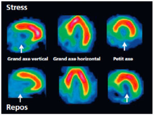 Figure 26.18 Scintigraphie myocardique au 99mTc-MIBI : nécrose. L'injection du traceur et l'acquisition des images sont réalisées au décours d'un effort (stress) et quelques heures plus tard au repos, après réinjection. On constate une absence de perfusion dans le territoire inférieur en post-stress (flèches), non réversible au repos. Il s'agit d'un aspect évocateur de nécrose myocardique dans ce territoire. Cependant, une ischémie « chronique » non réversible au repos (hibernation) ne peut pas être exclue.