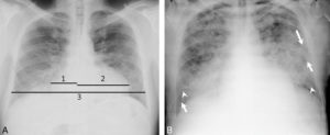 Figure 26.19 Insuffisance cardiaque. A. L'index cardiothoracique se mesure sur une radiographie thoracique de face, rayon incident postéro-antérieur, bien inspirée. Il correspond au rapport de la somme des deux diamètres des arcs médiastinaux inférieurs droit et gauche depuis la ligne médiane (ligne des processus épineux) par le plus grand diamètre interne du thorax : (1 + 2)/3. Dans ce cas, il a été mesuré à 0,58 (valeur normale < 0,50). Cette augmentation traduit la cardiomégalie. Les culs-de-sac latéraux sont libres. B. Œdème pulmonaire cardiogénique : élargissement médiastinal ; opacités floconneuses bilatérales par comblement alvéolaire ; quelques lignes de Kerley B (flèches) et C (têtes de flèche)