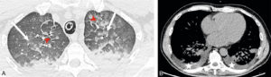 Figure 26.20 Insuffisance cardiaque. A. Coupe axiale de TDM thoracique en fenêtre parenchymateuse pulmonaire. Épaississement des septums interlobulaires par dilatation veineuse pulmonaire (têtes de flèche) et verre dépoli intralobulaire (flèches) traduisant l'engorgement alvéolaire. Condensations parenchymateuses pulmonaires postérieures. B. Coupe axiale de TDM thoracique en fenêtre médiastinale. Épanchement pleural bilatéral (étoiles), hypodense, avec concavité vers l'avant (déclivité).