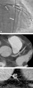 Figure 26.3 Exploration des coronaires par coronarographie et par coroscanner. A. Coronarographie montrant un rétrécissement du calibre de l'artère interventriculaire antérieure proximale (tête de flèche). Cathéter dans l'aorte (flèche blanche) et extrémité (flèche grise) à l'ostium du tronc coronaire gauche pour une injection sélective du vaisseau. B. Coroscanner en coupe fine (< 1 mm) montrant la même sténose (tête de flèche) par une plaque d'athérome mixte (composante hypodense, thrombus, et composante hyperdense calcifiée). C. Coroscanner avec reconstruction perpendiculaire à l'axe du vaisseau montrant la lumière circulante, excentrique (tête de flèche), et la plaque d'athérome mixte (thrombus, flèche grise) et calcifiée (flèche blanche).