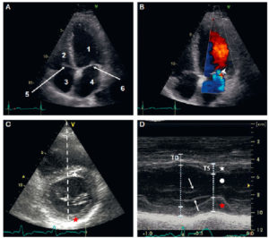 Figure 26.4 Échographie cardiaque par voie transthoracique. A. Coupe apicale quatre cavités (grand axe horizontal) en niveaux de gris. 1. VG ; 2. VD ; 3. atrium droit ; 4. atrium gauche ; 5. valve tricuspide ; 6. valve mitrale. B. Même coupe, avec mode Doppler couleur, pour étudier les flux de remplissage ventriculaire et évaluer la sévérité d'une valvulopathie ; noter d'ailleurs ici une insuffisance mitrale physiologique (tête de flèche). C. Repérage, sur la coupe petit axe, de la ligne analysée en mode TM. D. Les segments permettent de mesurer la paroi septale (étoile blanche), la cavité ventriculaire gauche (rond blanc), et la paroi latérale (étoile rouge) en télédiastole (TD) et télésystole (TS), et ainsi de calculer une fraction de raccourcissement – diamètre de la cavité en TD-diamètre en TS)/diamètre en TD ; feuillets valvulaires mitraux (flèches).