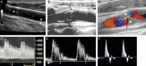 Figure 26.5 A. Échographie en niveaux de gris d'une artère carotide commune normale montrant la lumière normalement anéchogène (étoile blanche), la paroi (entre les deux têtes de flèche) avec la ligne hyperéchogène côté lumière correspondant à l'intima et la bande hypoéchogène à la média ; ici a été mesurée l'épaisseur intima-média, marqueur d'athérosclérose (valeur normale < 1 mm). B. Présence d'une plaque athéromateuse du bulbe carotidien avec une composante calcifiée (flèche blanche ; cône d'ombre acoustique postérieur) et une composante hypoéchogène (flèche grise). C. Sténose serrée d'une artère carotide interne par une plaque hypoéchogène (rond blanc) avec étude en Doppler couleur montrant un phénomène d'aliasing (flèche noire). D. Spectre Doppler correspondant avec mesure de la vitesse maximale à 4,1 m/s (sténose significative si > 2 m/s). E. Spectre Doppler normal d'une artère à faible résistivité, type carotide commune (vitesse maximale systolique autour de 1 m/s ici). F. Spectre Doppler normal d'une artère à haute résistivité, musculaire.