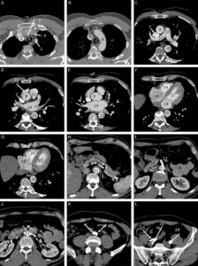 Figure 26.6 A-L. Anatomie normale en angio-TDM thoraco-abdominale (coupes axiales) au temps artériel. 1. Veine brachiocéphalique gauche ; 2. Veine brachiocéphalique droite ; 3. tronc artériel brachiocéphalique ; 4. artère carotide commune gauche ; 5. artère subclavière gauche ; 6. trachée ; 7. veine cave supérieure ; 8. crosse de l'aorte ; 9. aorte ascendante (segment 1) ; 10. aorte thoracique descendante (segment 3) ; 11. tronc de l'artère pulmonaire ; 12. branche droite de l'artère pulmonaire ; 13. branche gauche de l'artère pulmonaire ; 14. atrium gauche ; 15. auricule gauche ; 16. veines pulmonaires ; 17. ventricule gauche ; 18. atrium droit ; 19. ventricule droit ; 20. sinus coronaire ; 21. aorte abdominale ; 22. artère mésentérique supérieure ; 23. artère iliaque commune droite ; 24. artère iliaque commune gauche ; 25. artère iliaque externe droite ; 26. artère iliaque interne droite.