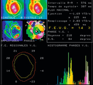 Figure 26.8 Ventriculographie isotopique.