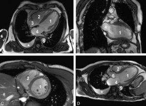 Figure 26.9 Séquences ciné-IRM dans les plans grand axe horizontal (A), grand axe vertical (B), petit axe (C) et un plan passant par la chambre de chasse du VG (D). 1. VG ; 2. VD ; 3. atrium droit ; 4. atrium gauche ; 5. aorte descendante ; 6. aorte ascendante. À noter qu'il existe un épanchement pleural droit liquidien, apparaissant en hypersignal sur ces images pondérées en T2/T1 (astérisque).
