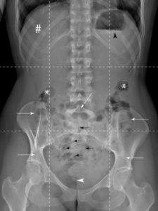 Figure 27.1 Exemple de radiographie d'abdomen sans préparation. La région abdominale est divisée en neuf quadrants limités par deux lignes verticales médioclaviculaires et deux lignes horizontales passant par le bord inférieur des cartilages costaux et par les épines iliaques antérosupérieures. Les quadrants supérieurs sont les hypochondres droit et gauche, séparés par l'épigastre. L'hypochondre droit et l'épigastre sont occupés par le foie (#), de densité homogène. L'hypochondre gauche est occupé par l'estomac et par la rate. Le niveau hydroaérique (tête de flèche noire) est lié au remplissage gastrique avec de l'air qui s'accumule dans le fundus. Sa présence témoigne d'un cliché réalisé en position debout. Les quadrants moyens sont les flancs droit et gauche, séparés par la région ombilicale. Les flancs contiennent le côlon (flèches blanches) (ascendant et descendant, ainsi que les angles coliques droit et gauche) (astérisques). La région ombilicale contient le côlon transverse (flèche blanche) et l'intestin grêle (flèches noires), principalement le jéjunum. Les quadrants inférieurs sont les fosses iliaques droite et gauche, séparées par l'hypogastre. La fosse iliaque droite contient le cæcum et l'appendice vermiculaire ; la fosse iliaque gauche contient le côlon sigmoïde ; l'hypogastre contient l'iléon, la vessie et le rectum. Les quatre densités sont visibles : densité aérique de l'air contenu dans le tube digestif (noir sur l'image), densité osseuse du rachis, du bassin et des côtes (blanc sur l'image), densité graisseuse de la graisse sous-cutanée (gris sombre sur l'image) et densité hydrique du foie et des reins (gris clair sur l'image).
