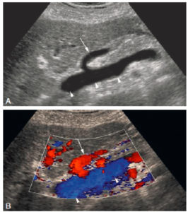 Figure 27.10 Exemple d'image échographique en mode B (A) et en mode Doppler couleur (B) centrée sur le pédicule hépatique. En mode B, les vaisseaux circulants apparaissent anéchogènes (ici la veine porte ; têtes de flèche). On note un vaisseau qui vient se jeter dans la veine porte et qui correspond à la veine gastrique gauche (flèche). Le Doppler couleur permet de savoir dans quelle direction circule le flux sanguin. Par définition, les flux codés en bleu s'éloignent de la sonde, et les flux codés en rouge se dirigent vers la sonde. Le flux dans la veine porte s'éloigne donc de la sonde en se dirigeant vers le foie. Le flux dans la veine gastrique gauche se dirige vers la sonde, donc s'échappe de la veine porte pour aller se diriger vers l'estomac, ce qui est pathologique.