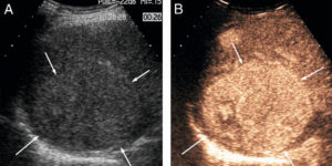 Figure 27.11 Exemple d'échographie de contraste. Lésion hépatique (flèches) avant injection de produit de contraste (A) et après injection (B). Avant injection, l'anomalie présente des niveaux de gris quasi identiques au foie adjacent (isoéchogène). Après injection, on observe un rehaussement (ici arbitrairement codé en orange) plus important au sein de la tumeur que du foie alentour car cette lésion est plus richement vascularisée que le foie.