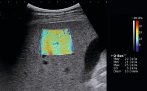 Figure 27.12 Exemple d'élastographie (ou élastométrie ultrasonore) du foie. Sur une image du foie en mode B, on positionne une région conique tronquée dans laquelle la machine va émettre des ondes ultrasonores particulières à l'origine de la propagation d'ondes de cisaillement dans le foie. La mesure de la vitesse de propagation de ces ondes de cisaillement par l'échographe renseigne sur la valeur du module de Young, affichée avec une échelle de couleur en chaque point de la zone de mesure et qui correspond à la dureté du tissu. Ici, les valeurs sont élevées (22,9 kPa dans la région d'intérêt ronde), ce qui correspond à un foie très dur de cirrhose.