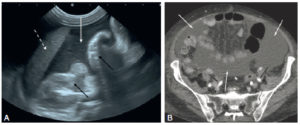Figure 27.14 Ascite en échographie et en TDM. En échographie (A), une coupe longitudinale passant par le bord inférieur du foie (flèche en pointillés). L'ascite est hypoéchogène (flèche blanche) et les anses digestives (flèches noires) sont visibles dans le liquide. En TDM (B), en coupe axiale après injection de produit de contraste iodé par intraveineuse (comme le montre le rehaussement des lumières vasculaires des artères iliaques) (flèches noires), on observe autour des anses digestives dont les parois sont rehaussées ou qui contiennent de l'air, une plage de densité hydrique (flèches blanches) qui correspond à un épanchement intrapéritonéal.